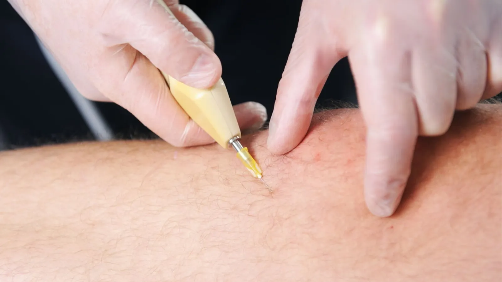 مدت ماندگاری کربوکسی تراپی