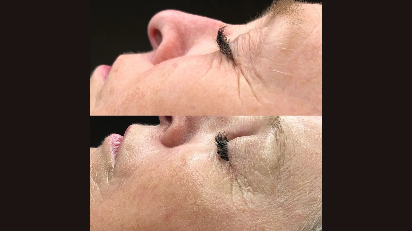 عکس قبل و بعد کربوکسی تراپی