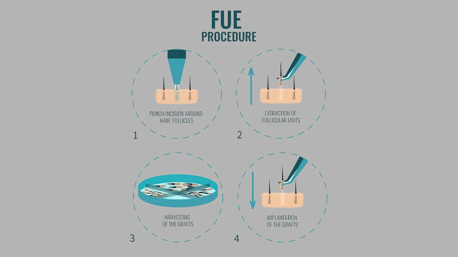 تعداد گرافت کاشت مو