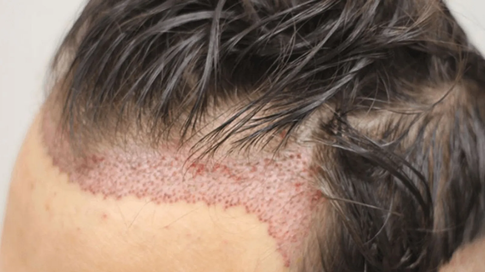 تصویر گرافت مو