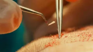 برداشت گرافت مو