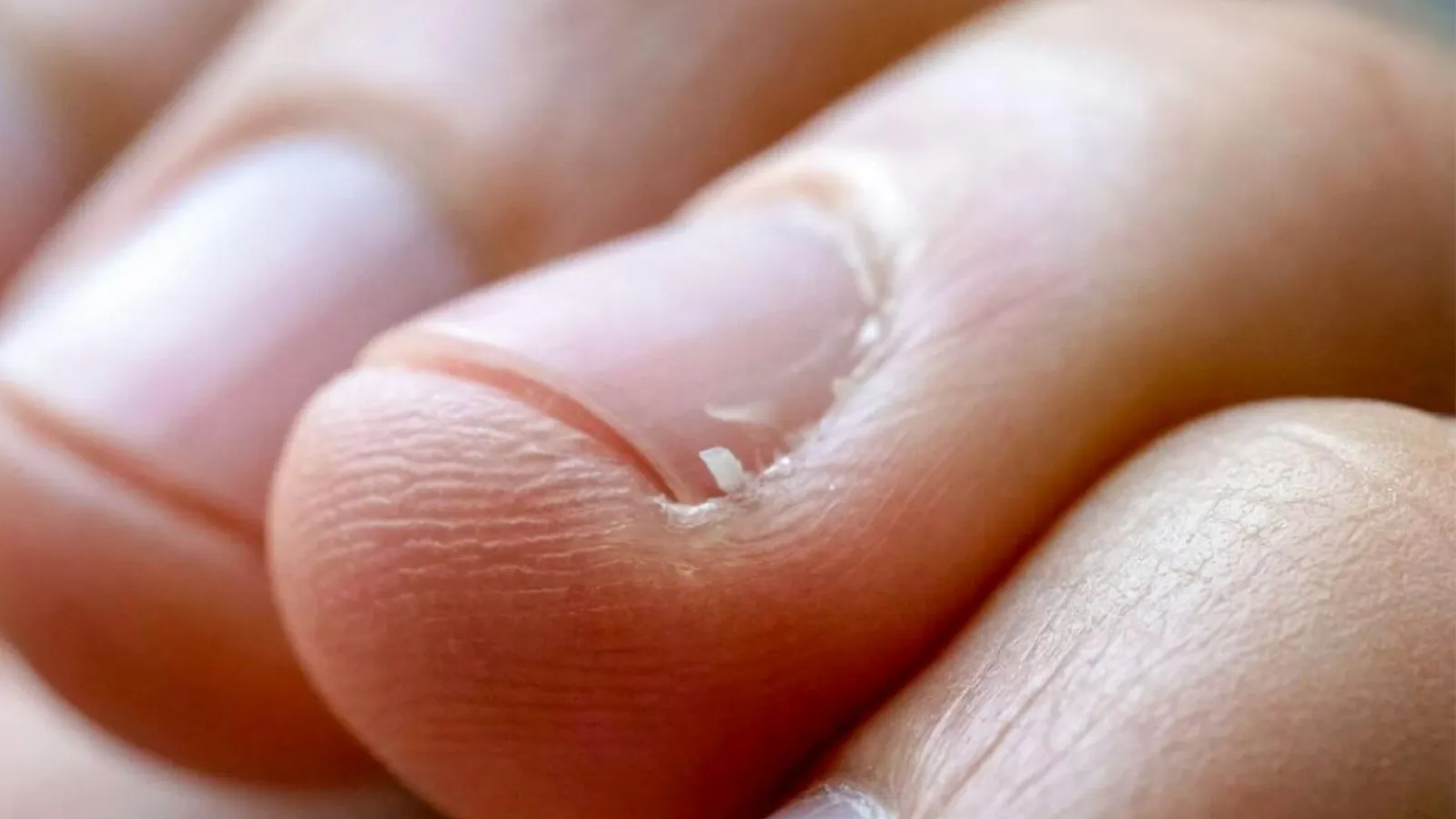 درمان خانگى ريش شدن پوست اطراف ناخن