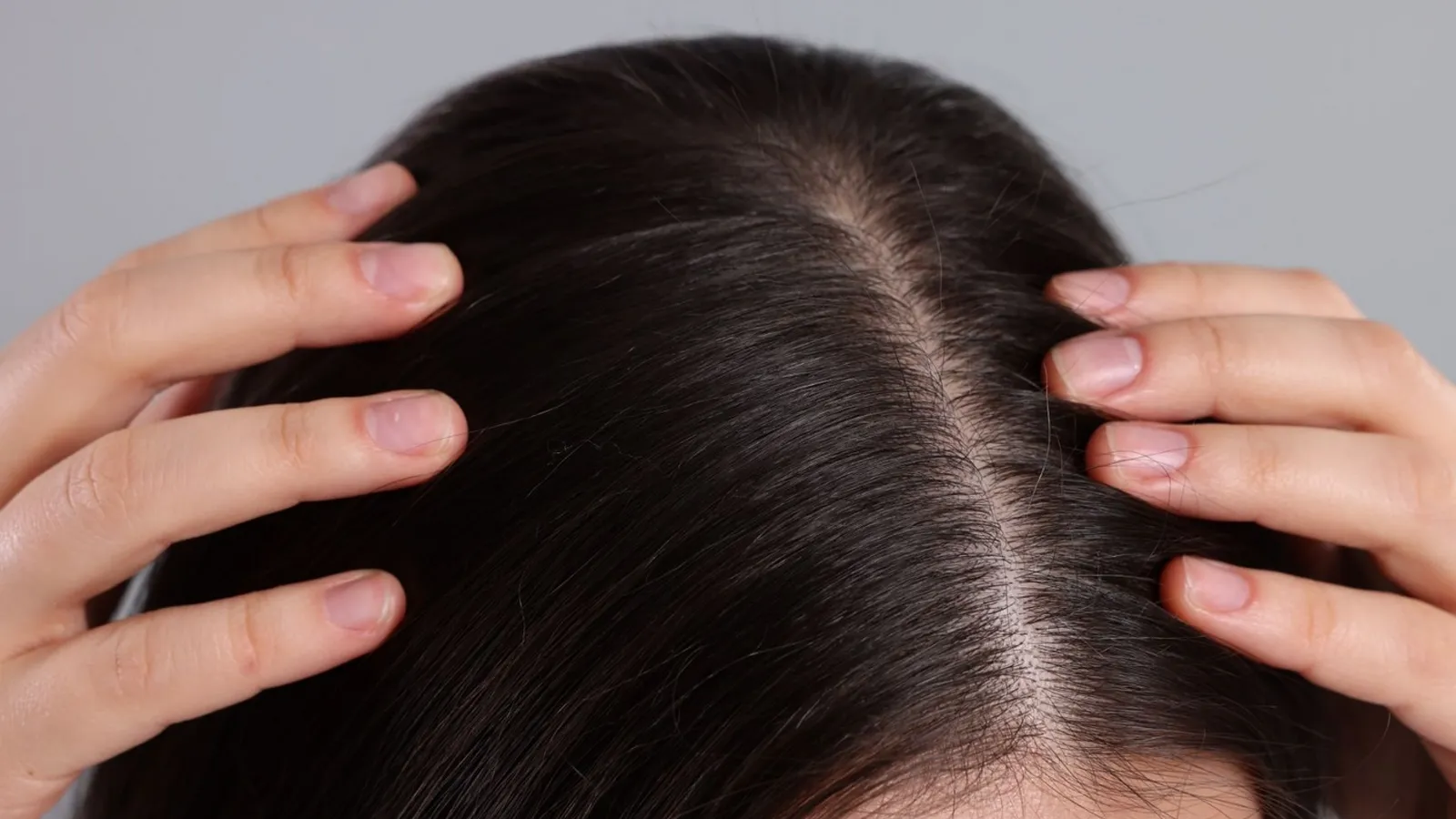 ریزش جلوی سر در خانمه