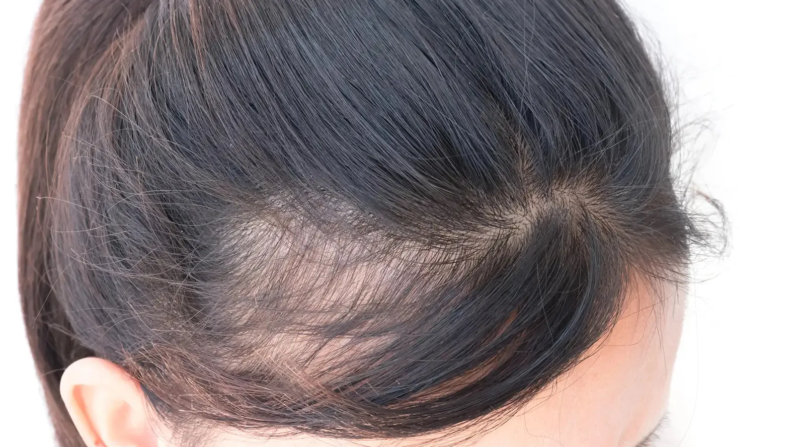 علت ریزش مو جلوی سر در زنان