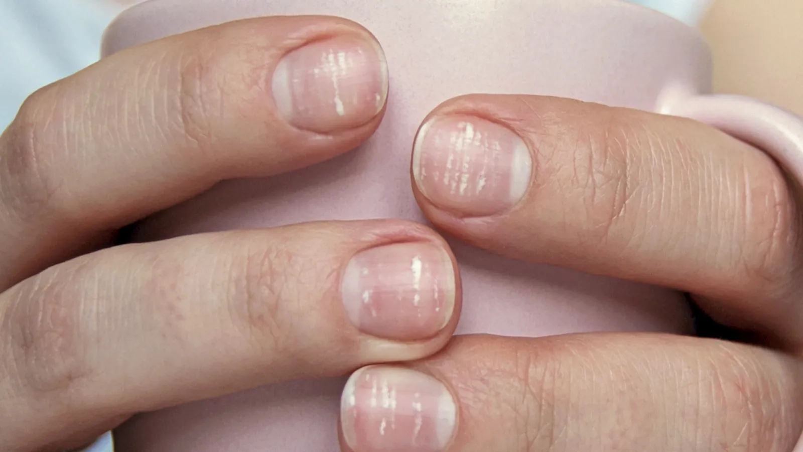  علت لكه سفيد روى ناخن كودك