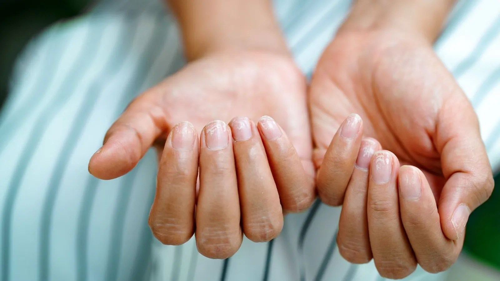  لكه سفيد روى ناخن كودک