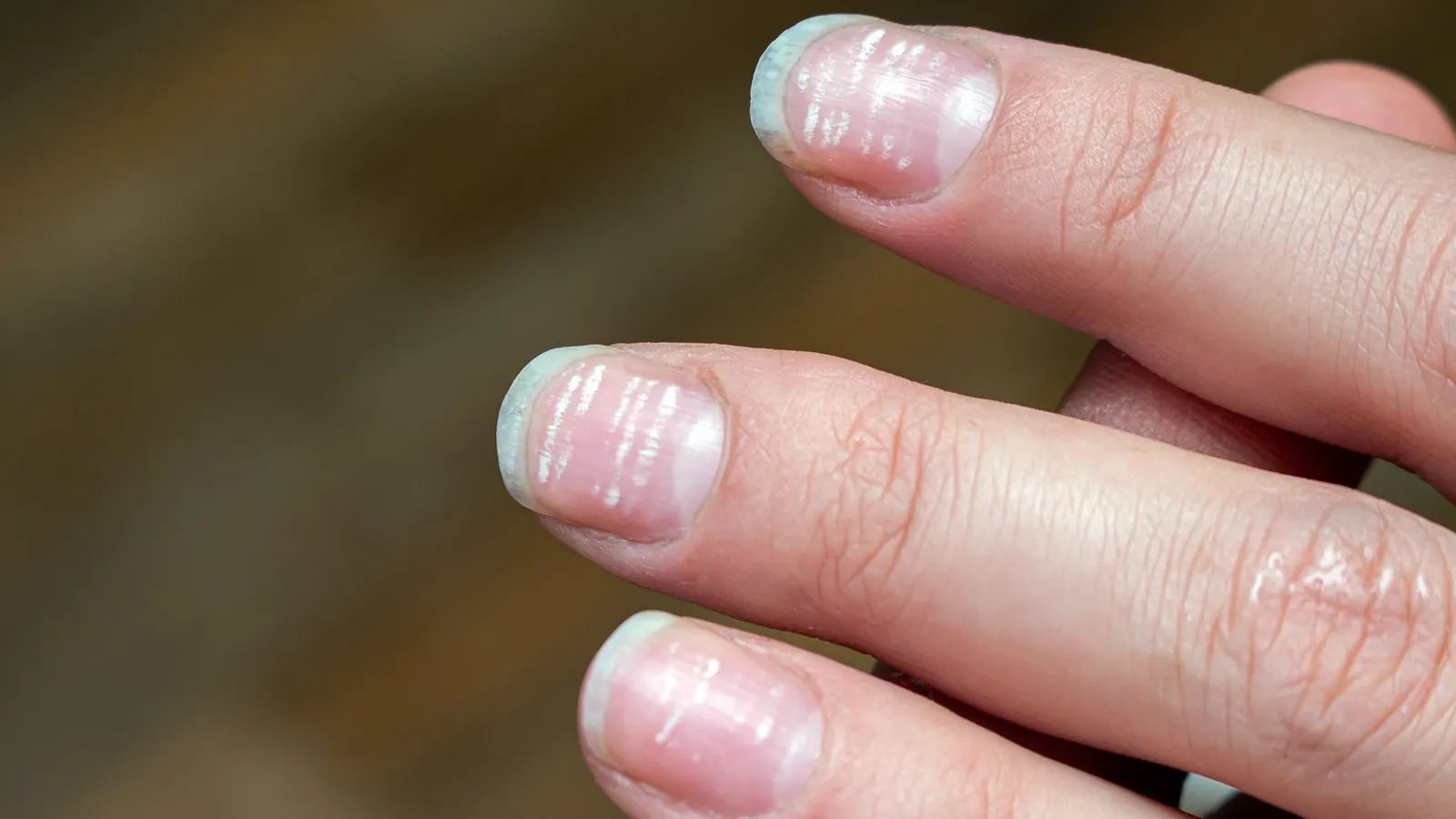 درمان سفيدى روى ناخن