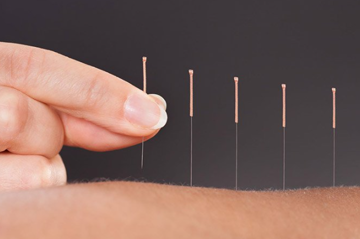 طب سوزنی  آذربایجان غربی