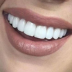 لمینت دندان  آذربایجان غربی