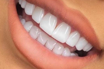 لمینت دندان  البرز