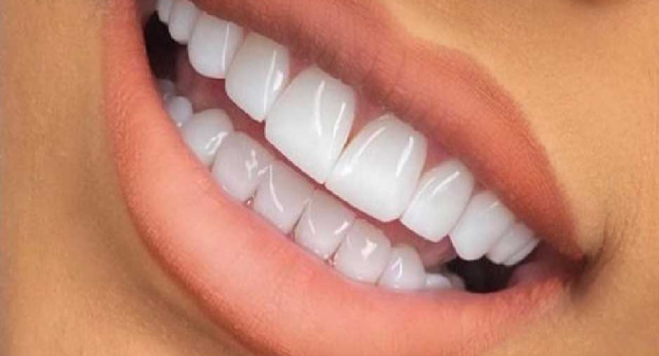 بهترین لمینت دندان  البرز