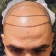 کلینیک کاشت مو شقاقی