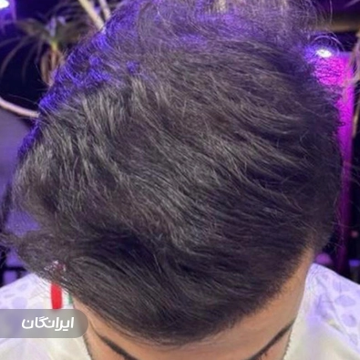 کلینیک کاشت مو سما