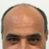 کلینیک کاشت مو رستا